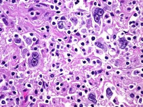 Sinais e sintomas, diagnóstico, tratamento, acompanhamento e perguntas para seu médico. Linfoma de Hodgkin X Linfoma não Hodgkin: qual é a diferença?