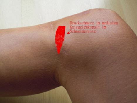 | 2 aufbauende übungen für schmerzfreie knie. Meniskusrisssymptome - Druckschmerz Kniegelenkspalt innen