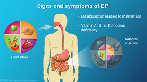 A nutritionist can help you create. Exocrine Pancreatic Insufficiency (EPI)