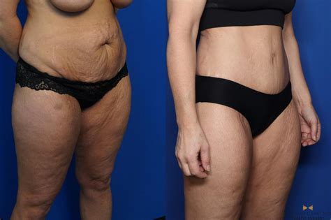 Who is a good bbl candidate? Liposuction Before & After Photos Patient 437 | Fort Worth ...