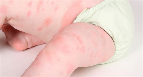 Poison ivy, oak, and sumac. Allergies in babies | BabyCenter