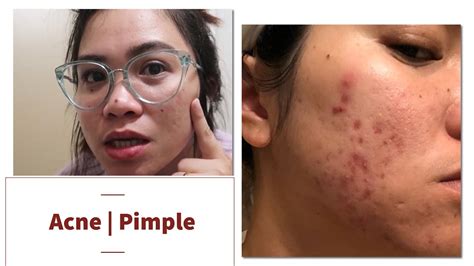 Nodules are inflammatory lesions with a diameter of 5 mm or greater. HOW I CLEARED MY ACNE | ACNE JOURNEY | Curology Review ...