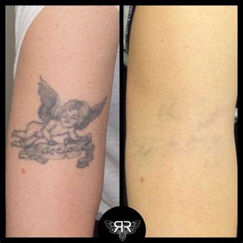 Pricing your laser treatments is a hurdle that all tattoo removal providers have to jump before starting to treat patients. x5 PicoSure sessions #tattooremovalpicosure # ...