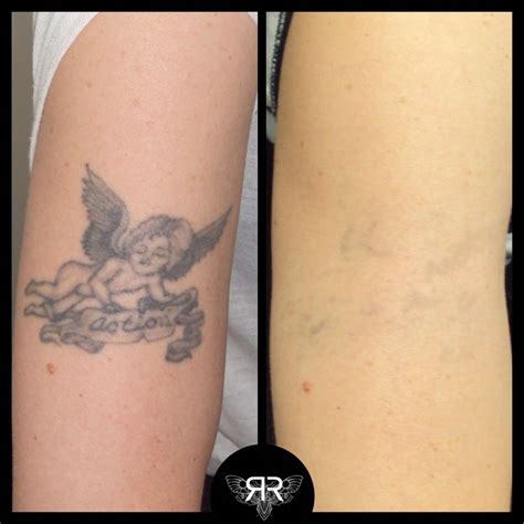 Pricing your laser treatments is a hurdle that all tattoo removal providers have to jump before starting to treat patients. x5 PicoSure sessions #tattooremovalpicosure # ...