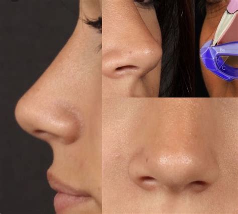 Before selecting a provider, get some referrals from for many patients who want to change the appearance of their nose, the fact that this can be done without surgery is a game changer. Pin by Mikayla Cobos on nose jobbbbbbb | Nose job ...