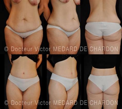 L'abdominoplastie est une chirurgie du ventre (souvent associée à une liposuccion du ventre ou un lifting des seins ) et est une bonne solution si vous ne savez plus comment perdre du ventre. Photos avant après de Body lift | Dr Victor Medard de Chardon
