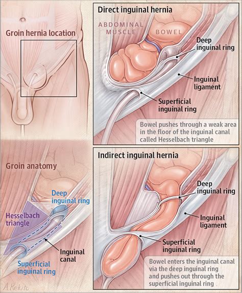These vessels help distinguish indirect from direct inguinal hernia. Groin Hernia | Surgery | JAMA | The JAMA Network