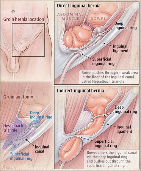 These can be serious so i would not wait to check it out. Groin Hernia | Surgery | JAMA | The JAMA Network