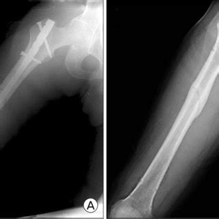 A radiograph shows completely displaced short oblique ...