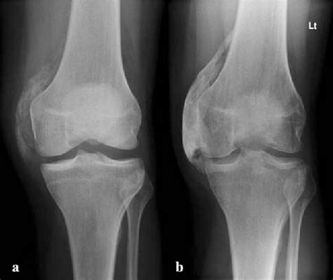 #foamed #foamrad #radiology #rad #elearnrad #voxelz #varunbabu #drbabu. Figure 1 from Good result after surgical treatment of ...