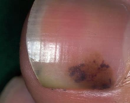 There's not much you can do for a benign mole under your toenail. Subungual Melanoma Pictures - 27 Photos & Images ...