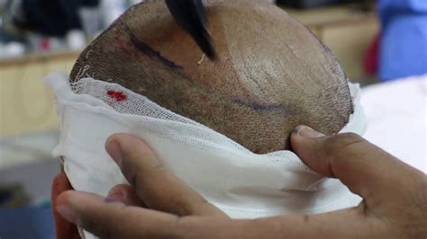 You will be able to. Procedure of FUE Hair Transplant in India, गंजेपन का इलाज ...