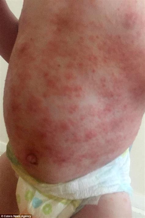 There are two types of hsv that can cause a skin rash in different areas: Toddler nearly died after catching herpes from a kiss ...