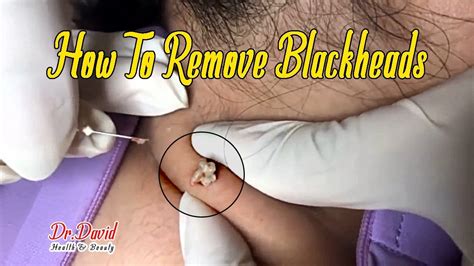 With the menu displ… read more. How to get rid of blackhead on neck - How to remove ...