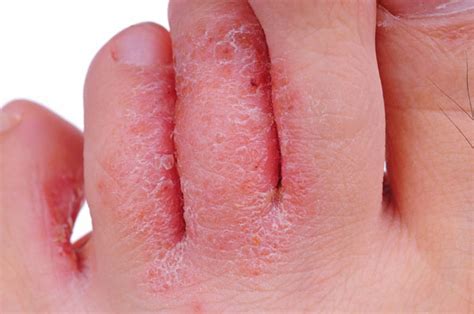 Symptoms of foot fungus tend to come up as a result of neglecting this part of the body and they can be a very painful condition. List of Some Common Fungal Infections With Their Treatment ...