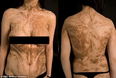 Webmd's skin anatomy page provides a detailed image of the skin and its parts as well as a medical definition. Human skin is covered in stripes of different colours only ...