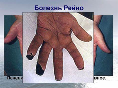 Рейно болезнь диета Заболевания периферических артерий (артериальная недостаточность Заболевания периферических артерий (артериальная недостаточность Рейно болезнь диета