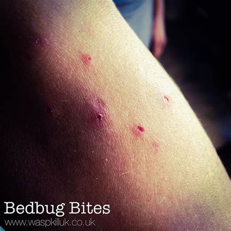 In this article, you will learn how long bed bug bites last and what you can do to speed up the healing process. Bed bug bites can scar and these can last a lifetime. Don ...