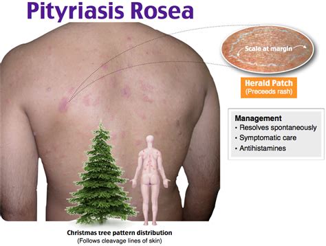 We did not find results for: Pin on Pityriasis rosea