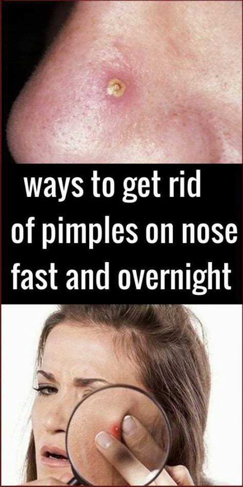 Leave it on for about 15. ways to get rid of pimples on nose fast and overni... - # ...