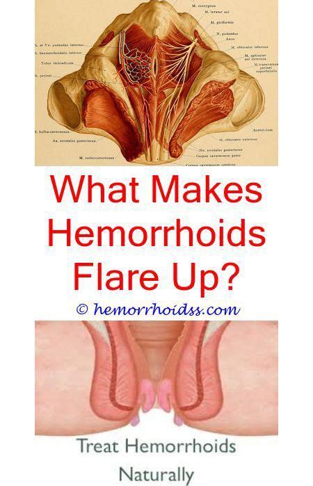 Recovery time after hernia surgery. What Relieves Itching From Hemorrhoid? can you get rid of ...