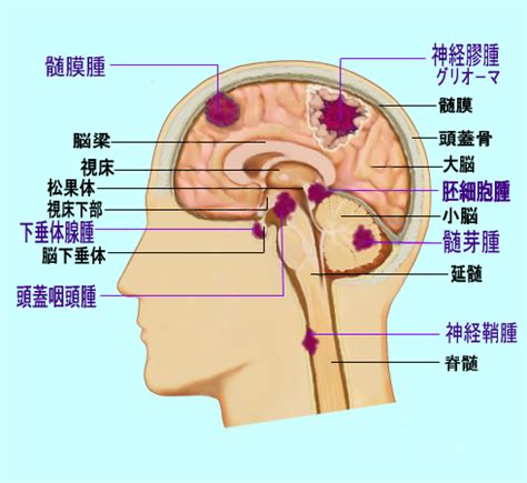 广州现代肿瘤医院癌症专家提醒：如患 上 食道癌 应 及 时到正规的医院进行治疗，并保持良好的心态抗击癌症。 面，包括治疗早期呼吸消化道癌症的缓解疗法、诱导治疗和明确的干预措施。 癌 転移 言語障害