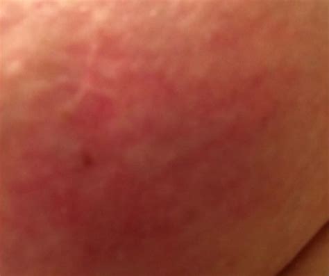 Inflammatory breast cancer is a rare type of cancer that often does not cause a breast lump or mass. Mom's Inflammatory Breast Cancer That Looked Like a ...