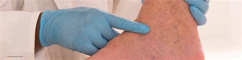 Wenn sich die venen einer person in einem normalen zustand befinden, sind sie auf der hautoberfläche nicht sichtbar, unabhängig von der hautfarbe. FA Innere Medizin und Angiologie