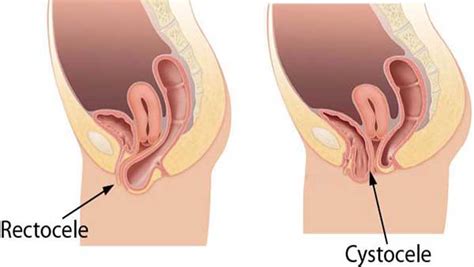 Plus souvent liée à des désordres hormonaux, la chute des cheveux touche une femme de plus de 50 ans sur cinq. La rectocèle : urologie chez la femme - Centre Urologie ...