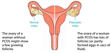 Ovarian cancer is rare but, sadly, typically has a poor prognosis mainly because it isn't diagnosed early. Abdominal and Ovarian Pain in Women | Medchrome