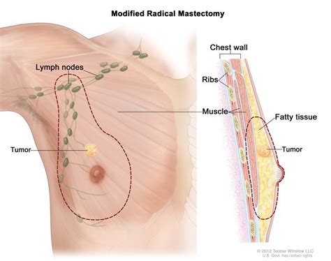 About 2 out of 3 invasive breast cancers are found in women 55 or older. National Cancer Institute on Twitter: "Breast cancer may ...