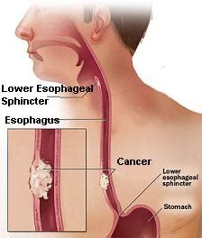 Usually, a diagnosis is made when the. Esophageal Cancer Detection and Diagnosis | Chemotherapy