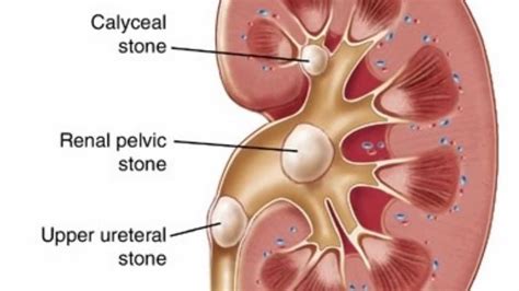 Kidney stones (also called renal calculi, nephrolithiasis or urolithiasis) are hard deposits made of minerals and salts that form inside your kidneys. Get Rid of Kidney Stones Naturally - The Wise Alternative ...