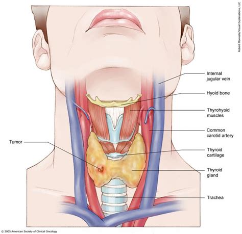 Cancer that starts in the lymph nodes is called lymphoma. Thyroid Cancer: Stages | Cancer.Net