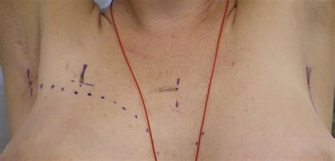 Can tattoos give you cancer? THE WHY? FOUNDATION: WHAT DOES RADIATION LOOK LIKE?
