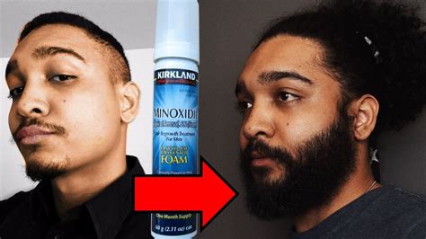 Using minoxidil speeds beard growth and development and allows faster results! 14 Men Who Grew A Beard With Minoxidil - YouTube