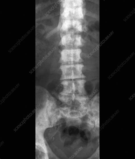 Though most throat cancers involve the same types of cells, specific terms are used to differentiate the part of the throat where cancer originated. Secondary spinal cancer, X-ray - Stock Image C026/9859 ...