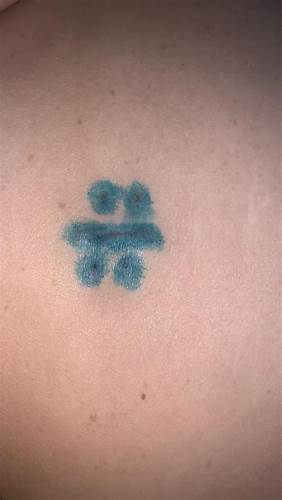 Лапароскопия желчного пузыря диета после Воспаление шва после лапароскопии жёлчного пузыря - Вопрос хирургу - 03 Воспаление шва после лапароскопии жёлчного пузыря - Вопрос хирургу - 03 Лапароскопия желчного пузыря диета после