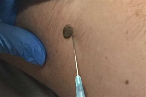 Your doctor will use the abcde guide to assess your mole. Mole Removal London | Best Mole Removal Mayfair, London ...