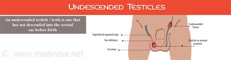 Cryptorchidism, disorder in which one or both of the testes do not descend spontaneously to the usual britannica, the editors of encyclopaedia. Undescended Testicles | Cryptorchidism - Causes ...