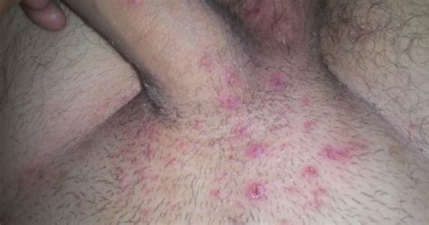 An ingrown hair happens when the sharp tip of the hair curls back or grows sideways into the skin of the hair follicle. rash on penile shaft - pictures, photos