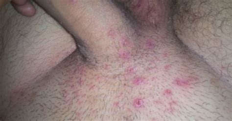 Ingrown hair on penis base or penile shaft can be itchy, painful and unsightly. rash on penile shaft - pictures, photos