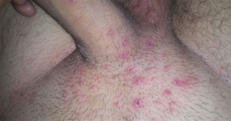 This can happen in any area with hair, including the pubic area. rash on penile shaft - pictures, photos