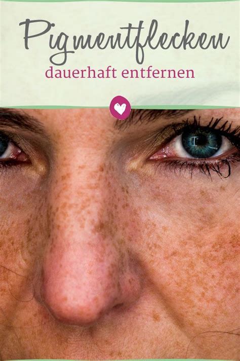 Entfernen sie pigmentflecken im gesicht mit pigmentclar produkten von la roche posay und finden sie eine passende dermatologische antwort auf ihre fragen. So können Sie Pigmentflecken dauerhaft entfernen ...