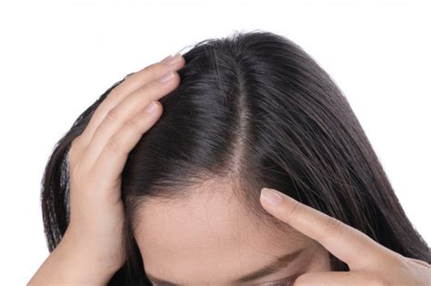 Souvent localisée sur le dessus de la tête, la perte de cheveux est progressive, renvoyant l'image d'un cheveu qui s'affine. Les jeunes femmes asiatiques s'inquiètent de la perte de cheveux, de la tête chauve et des ...