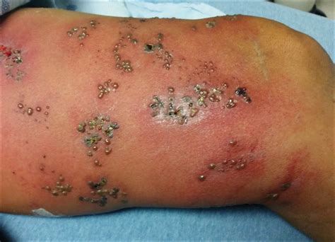 Powerful hsv 1 & 2 update 2019. Atypical Disseminated Herpes Zoster: Management Guidelines ...
