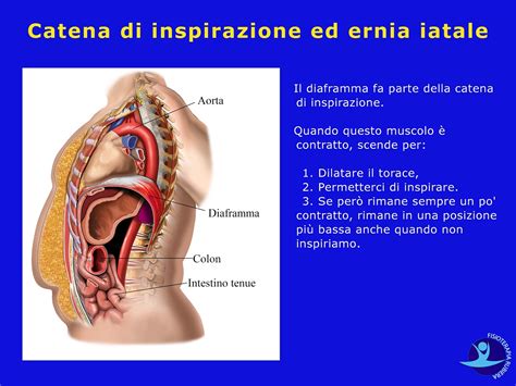 La perdita di peso può prevenire ripetersi ernia iatale. Come Curare l'Ernia Iatale con Osteopatia e Rimedi Naturali