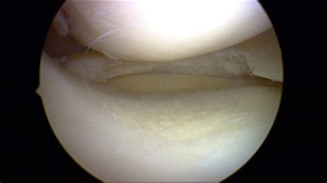 Dadurch öffnest du deine hüfte und du ermöglichst maximale spannung auf. Meniskus-Operation durch Dr. Goldmann - ein positives ...