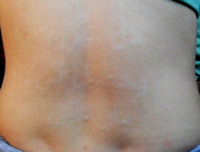 Once tca has made contact with the skin, it promotes skin cell turnover, which causes the skin to peel. TCA Peeling After a Laser Tattoo Removal? (photo) Doctor ...