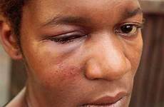 cheekbone swelling bruising person bruises after cuts woman beaten broken fractured ethnic great show skin dark pixgood
